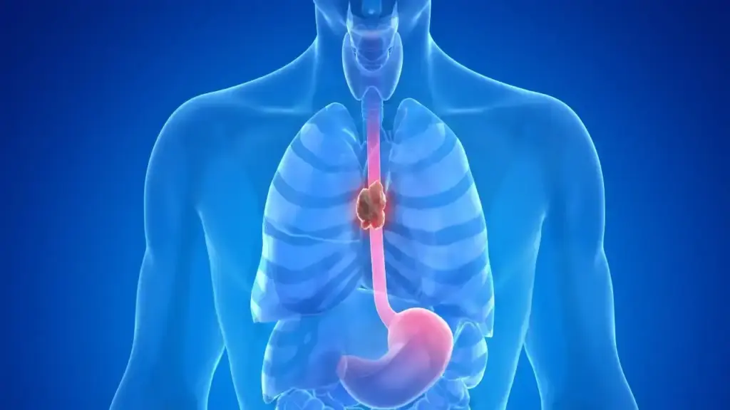 Persistent cough and throat problems can be a sign of esophageal cancer, do not ignore it.