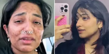 Skin changed with two easy changes: Video of 23 year old girl from Dubai goes viral