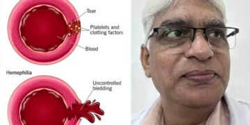 World Haemophilia Day: Management of bleeding is possible with Unani medicine – Dr. Liaquat Ali Mansoori