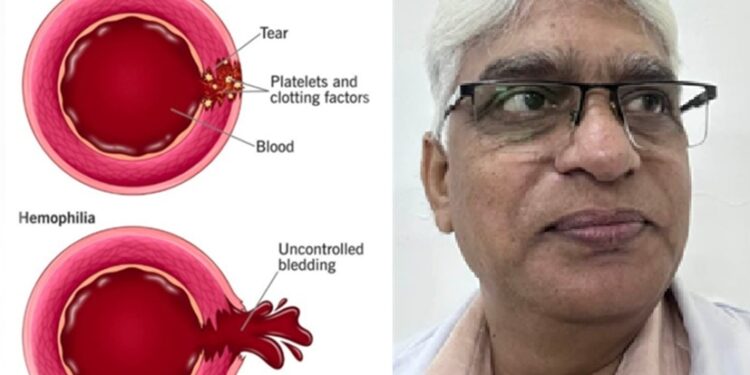 World Haemophilia Day: Management of bleeding is possible with Unani medicine – Dr. Liaquat Ali Mansoori