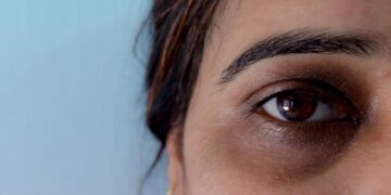 ≡ 7 Natural Ways to Get Rid of Dark Circles 》 Her Beauty