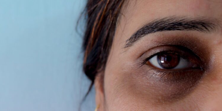 ≡ 7 Natural Ways to Get Rid of Dark Circles 》 Her Beauty