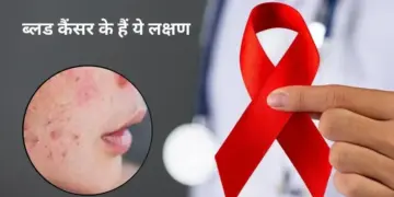 Blood Cancer Warning Signs: Do not ignore persistent rashes appearing on the skin, it can be a serious disease.