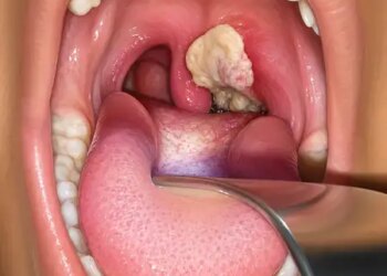 Diphtheria outbreak in Australia, infection spread from Northern Territory to Queensland and South Australia