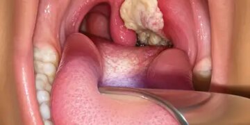 Diphtheria outbreak in Australia, infection spread from Northern Territory to Queensland and South Australia