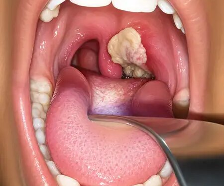 Diphtheria outbreak in Australia, infection spread from Northern Territory to Queensland and South Australia