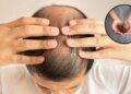 Hair Fall Remedy: Are you troubled by hair fall and baldness? Celebrity hair stylist told the special recipe of onion-garlic and mustard oil