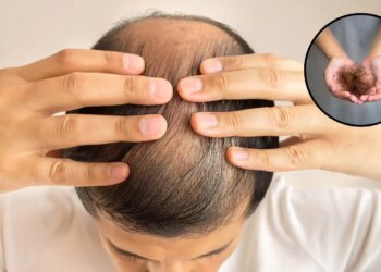 Hair Fall Remedy: Are you troubled by hair fall and baldness? Celebrity hair stylist told the special recipe of onion-garlic and mustard oil