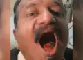 Surprising case: A man kept a pin in his mouth for 45 years, even doctors were stunned