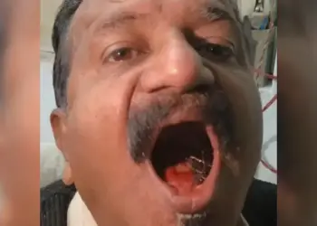 Surprising case: A man kept a pin in his mouth for 45 years, even doctors were stunned