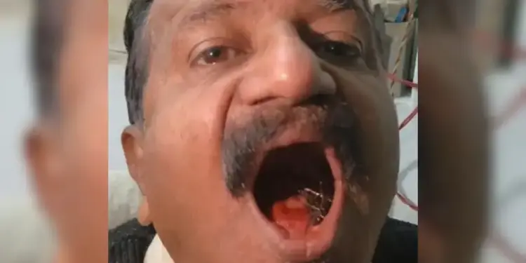 Surprising case: A man kept a pin in his mouth for 45 years, even doctors were stunned