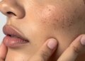 The pH balance of the skin deteriorates due to sunlight, stress and wrong eating habits, and may lead to the problem of acne and dryness.