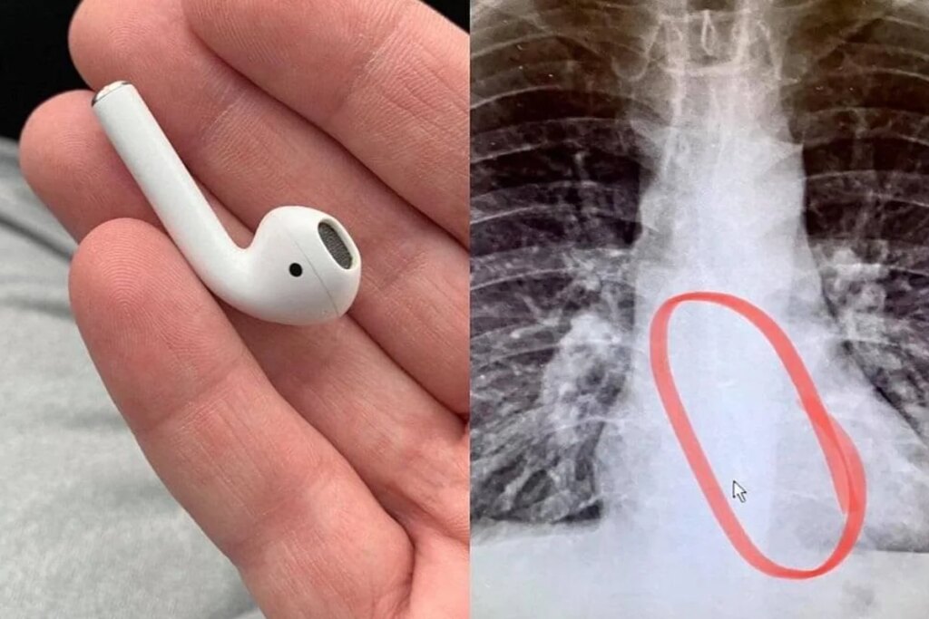 Woman swallowed Airpods thinking it was medicine, what happened next shocked her senses