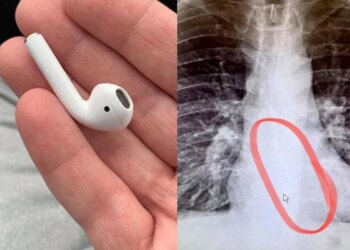 Woman swallowed Airpods thinking it was medicine, what happened next shocked her senses