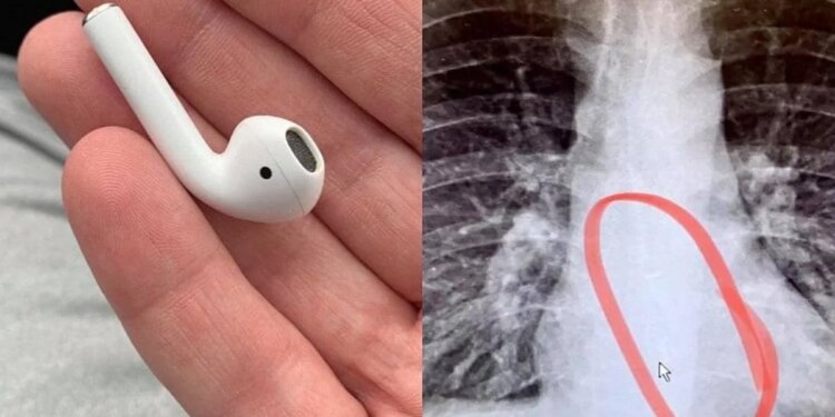 Woman swallowed Airpods thinking it was medicine, what happened next shocked her senses
