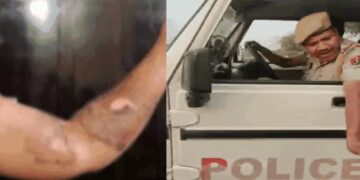 Jaipur: Case of throwing boiling water on a girl, accused policeman present in line; Government will bear the entire cost of treatment