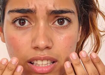 Risk of sunburn increases in strong sunlight, get relief from aloe vera, cucumber and rose water.