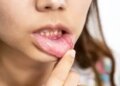 Adopt these easy remedies for mouth ulcers; Will provide relief from burning sensation, pain and difficulty in eating