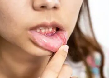 Adopt these easy remedies for mouth ulcers; Will provide relief from burning sensation, pain and difficulty in eating