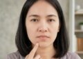 Hormonal changes can spoil facial complexion, this is how the risk of acne increases before periods.