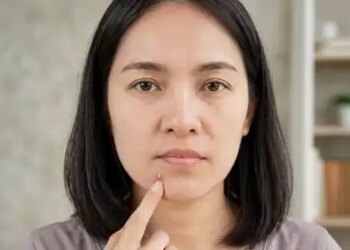 Hormonal changes can spoil facial complexion, this is how the risk of acne increases before periods.